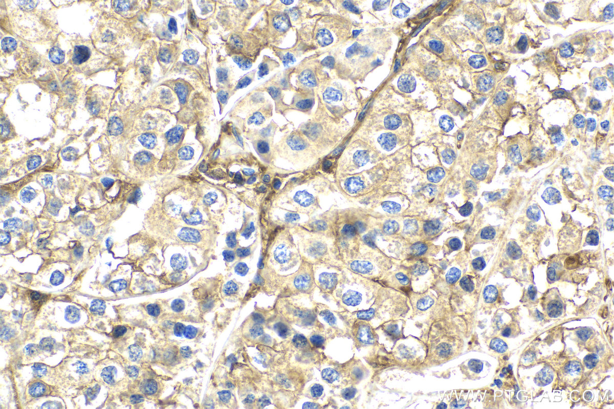 Immunohistochemical analysis of paraffin-embedded human endometrial cancer tissue slide using KHC2119 (RP2 IHC Kit).