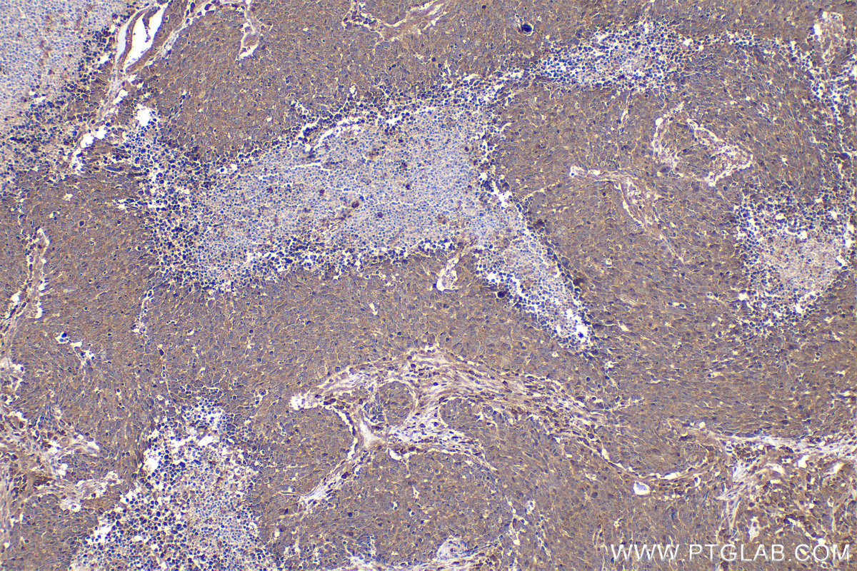 Immunohistochemical analysis of paraffin-embedded human lung cancer tissue slide using KHC2286 (RPL34 IHC Kit).