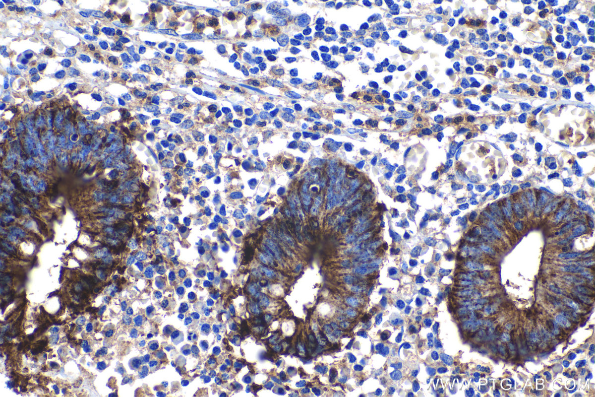 Immunohistochemical analysis of paraffin-embedded human appendicitis tissue slide using KHC1192 (S100A14 IHC Kit).