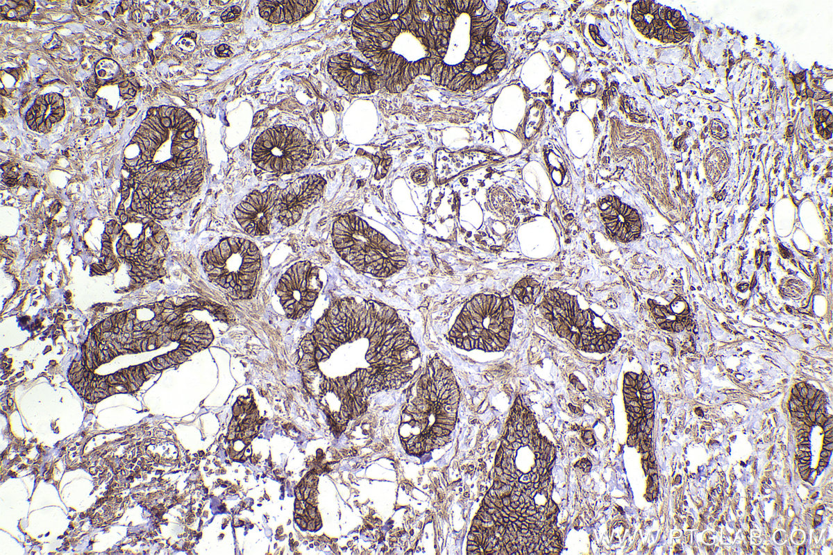 Immunohistochemical analysis of paraffin-embedded human rectal cancer tissue slide using KHC2450 (SCRIB IHC Kit).