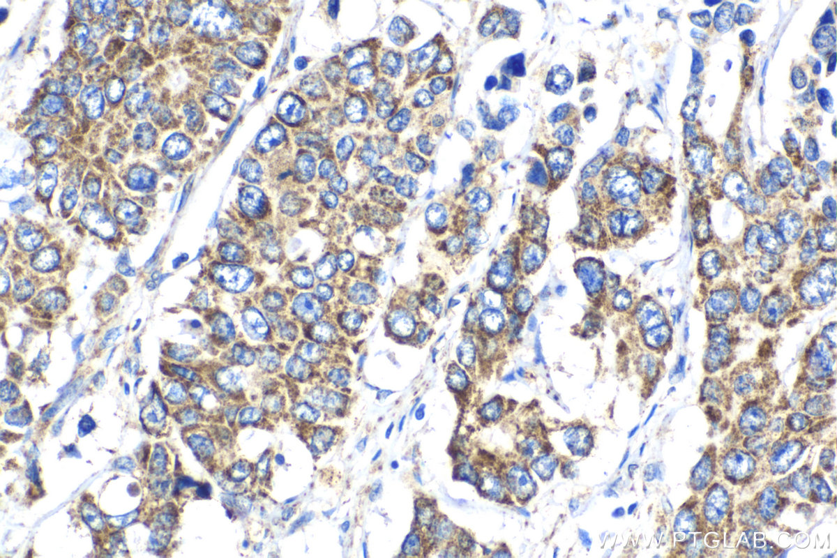 Immunohistochemical analysis of paraffin-embedded human stomach cancer tissue slide using KHC2054 (SDHD IHC Kit).