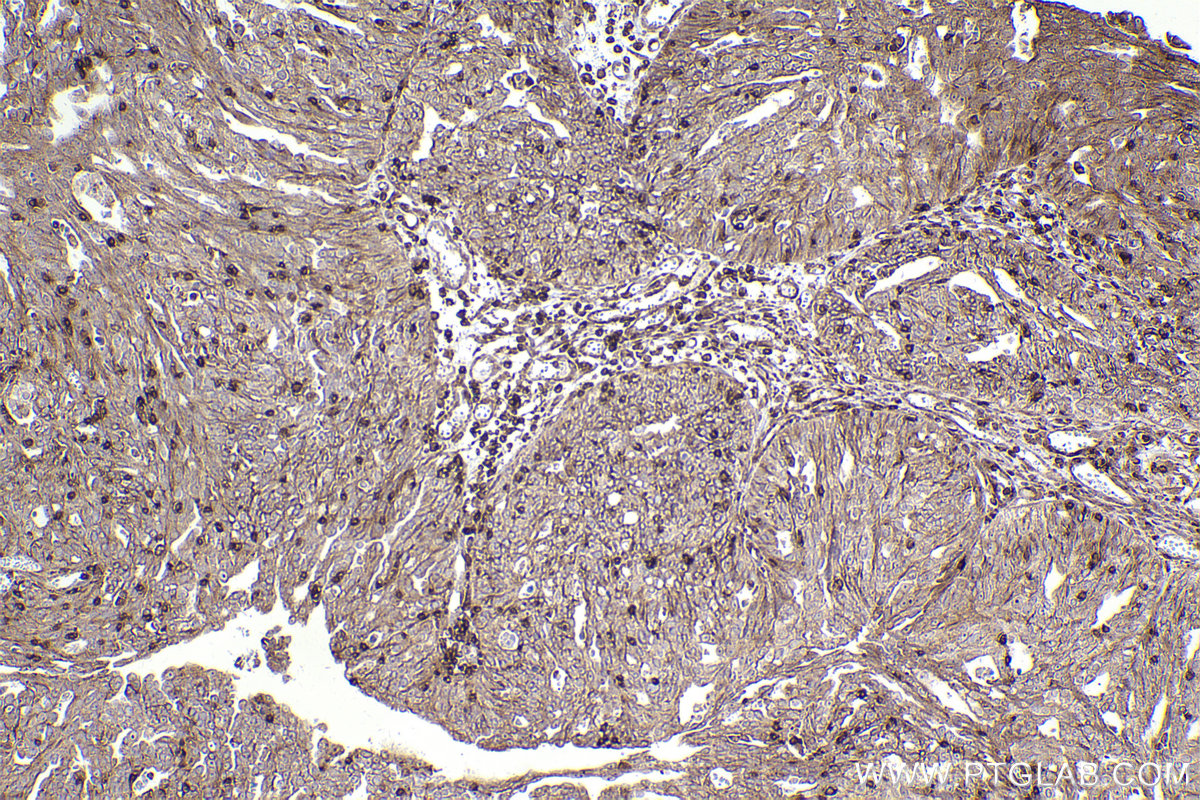 Immunohistochemical analysis of paraffin-embedded human ovary cancer tissue slide using KHC2448 (SEPT6 IHC Kit).