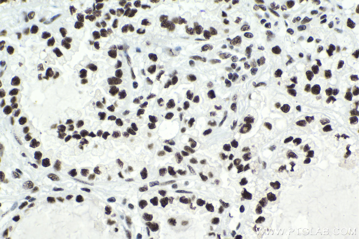 Immunohistochemical analysis of paraffin-embedded human lung cancer tissue slide using KHC1751 (SF3B3 IHC Kit).
