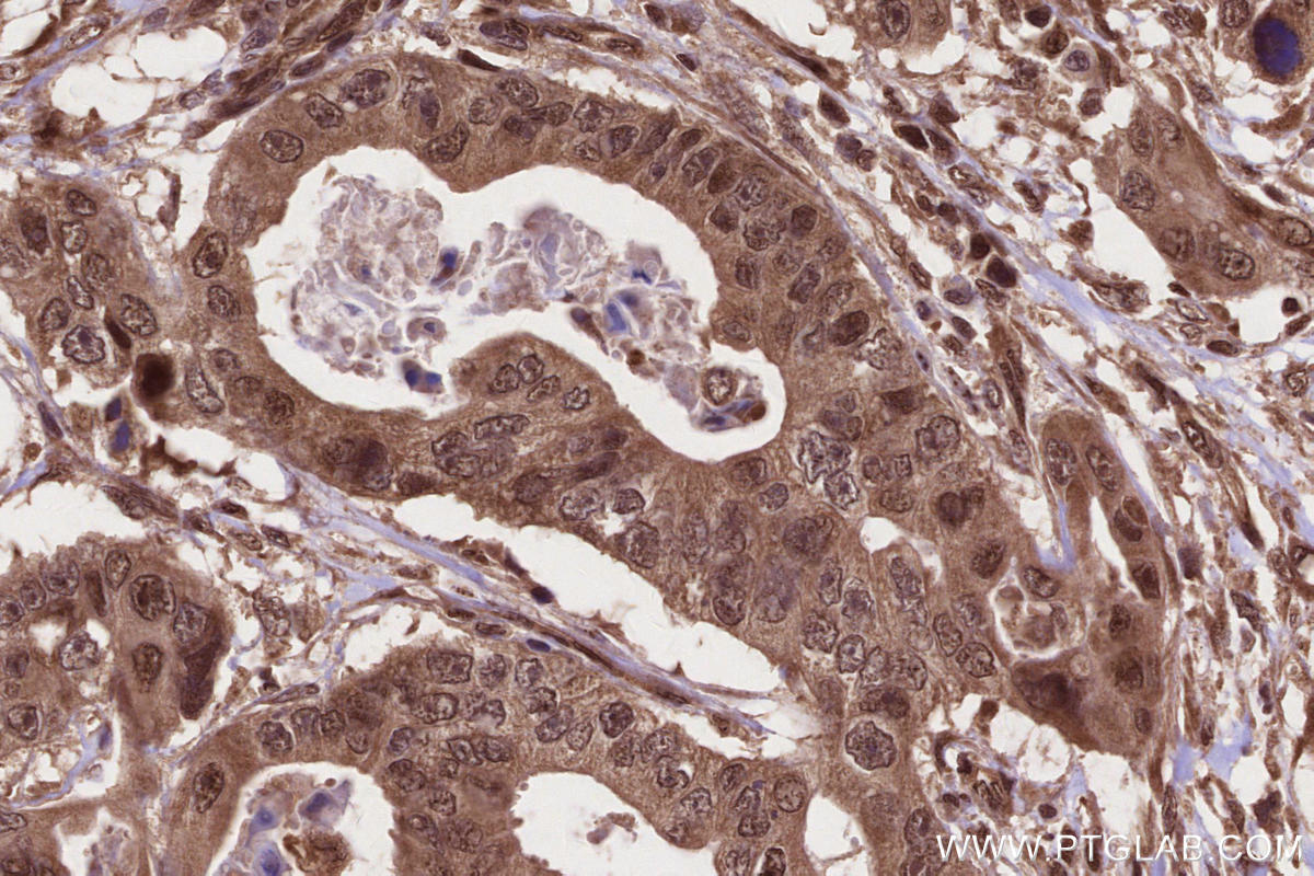 Immunohistochemical analysis of paraffin-embedded human stomach cancer tissue slide using KHC2680 (SIRT6 IHC Kit).