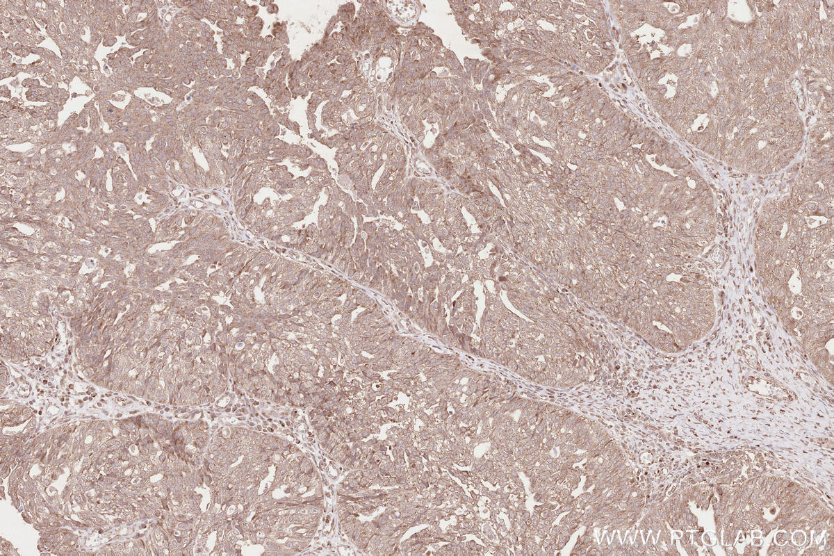 Immunohistochemical analysis of paraffin-embedded human ovary cancer tissue slide using KHC2583 (SLC30A6/ZNT6 IHC Kit).