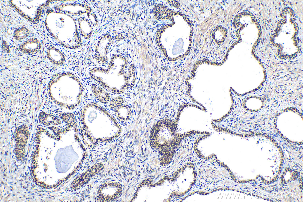 Immunohistochemical analysis of paraffin-embedded human prostate cancer tissue slide using KHC1212 (SMARCE1 IHC Kit).