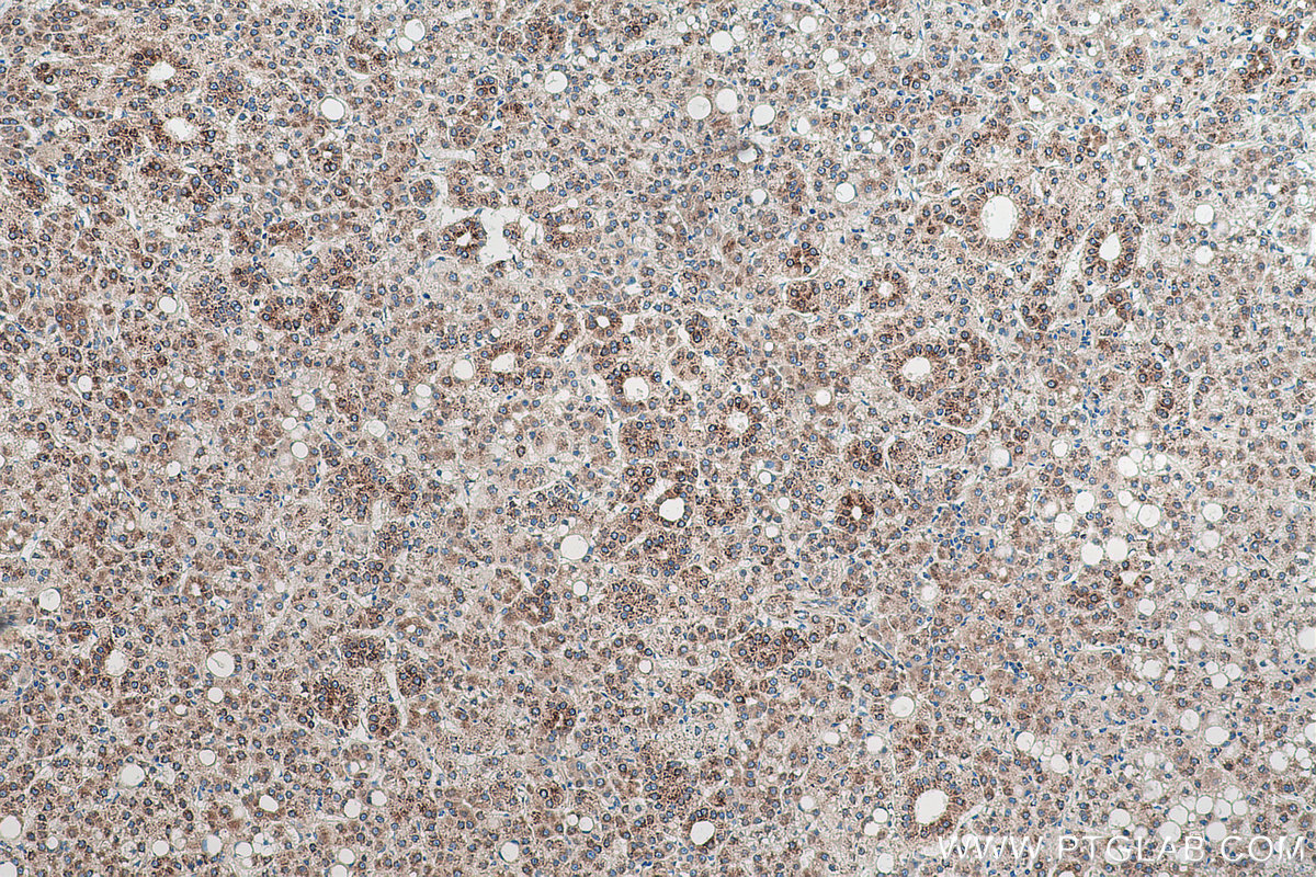 Immunohistochemical analysis of paraffin-embedded human liver cancer tissue slide using KHC0954 (SND1 IHC Kit).