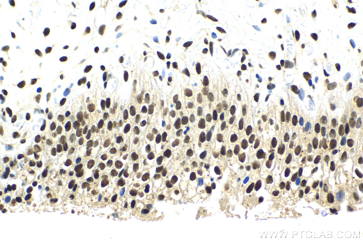 Immunohistochemical analysis of paraffin-embedded human urothelial carcinoma tissue slide using KHC2118 (SNRNP200 IHC Kit).