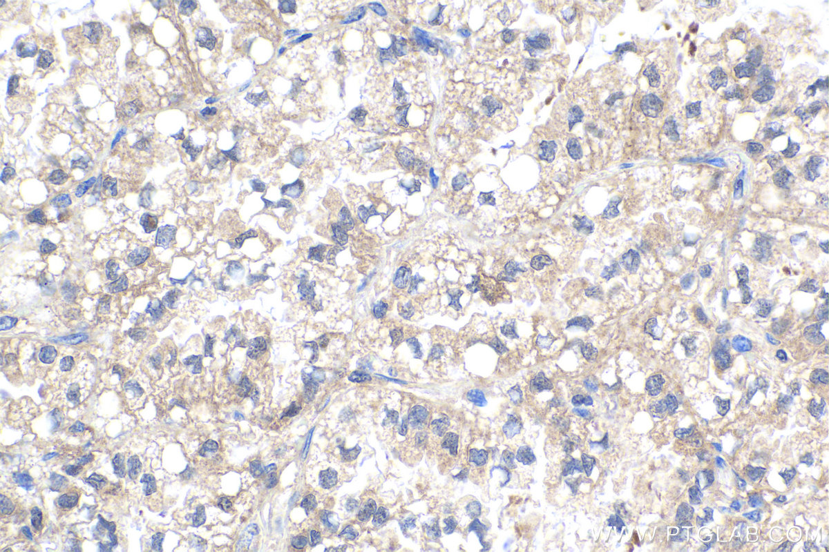 Immunohistochemical analysis of paraffin-embedded human lung cancer tissue slide using KHC1950 (SRA1 IHC Kit).