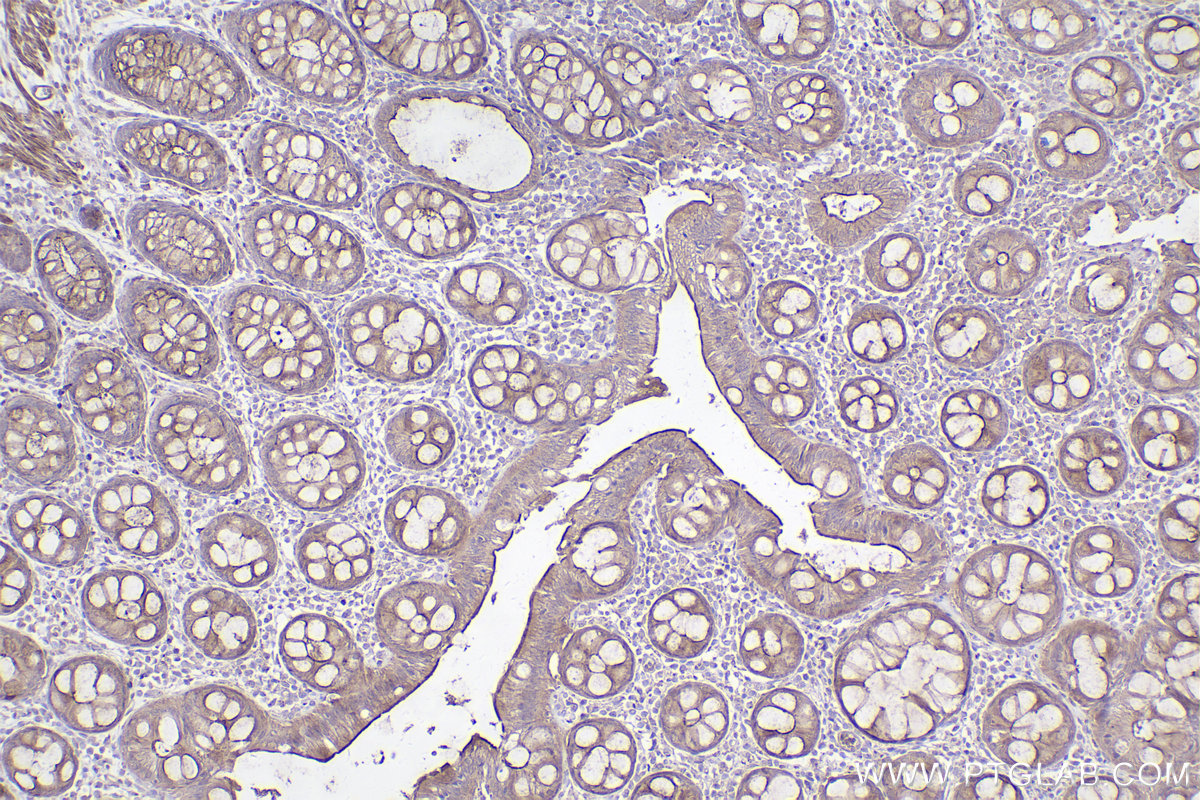 Immunohistochemical analysis of paraffin-embedded human rectal cancer tissue slide using KHC2489 (STIL IHC Kit).