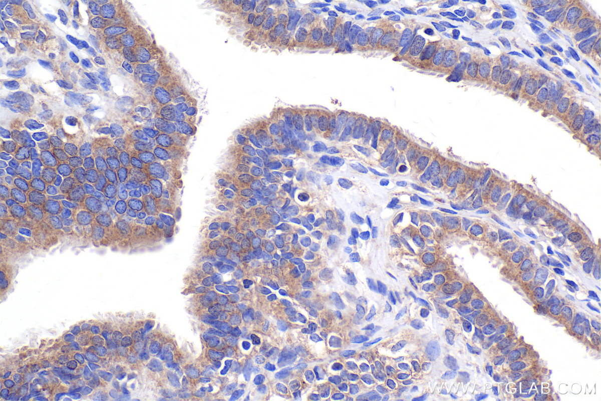 Immunohistochemical analysis of paraffin-embedded human ovary tumor tissue slide using KHC2415 (STRN3 IHC Kit).