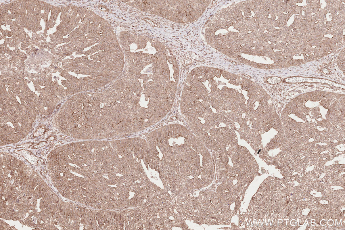 Immunohistochemical analysis of paraffin-embedded human ovary cancer tissue slide using KHC2608 (STXBP4 IHC Kit).