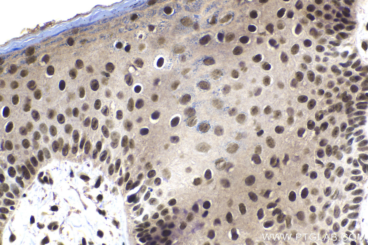 Immunohistochemical analysis of paraffin-embedded human skin cancer tissue slide using KHC2026 (SUPT16H IHC Kit).
