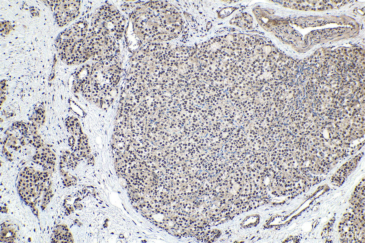 Immunohistochemical analysis of paraffin-embedded human thyroid cancer tissue slide using KHC1857 (SYMPK IHC Kit).
