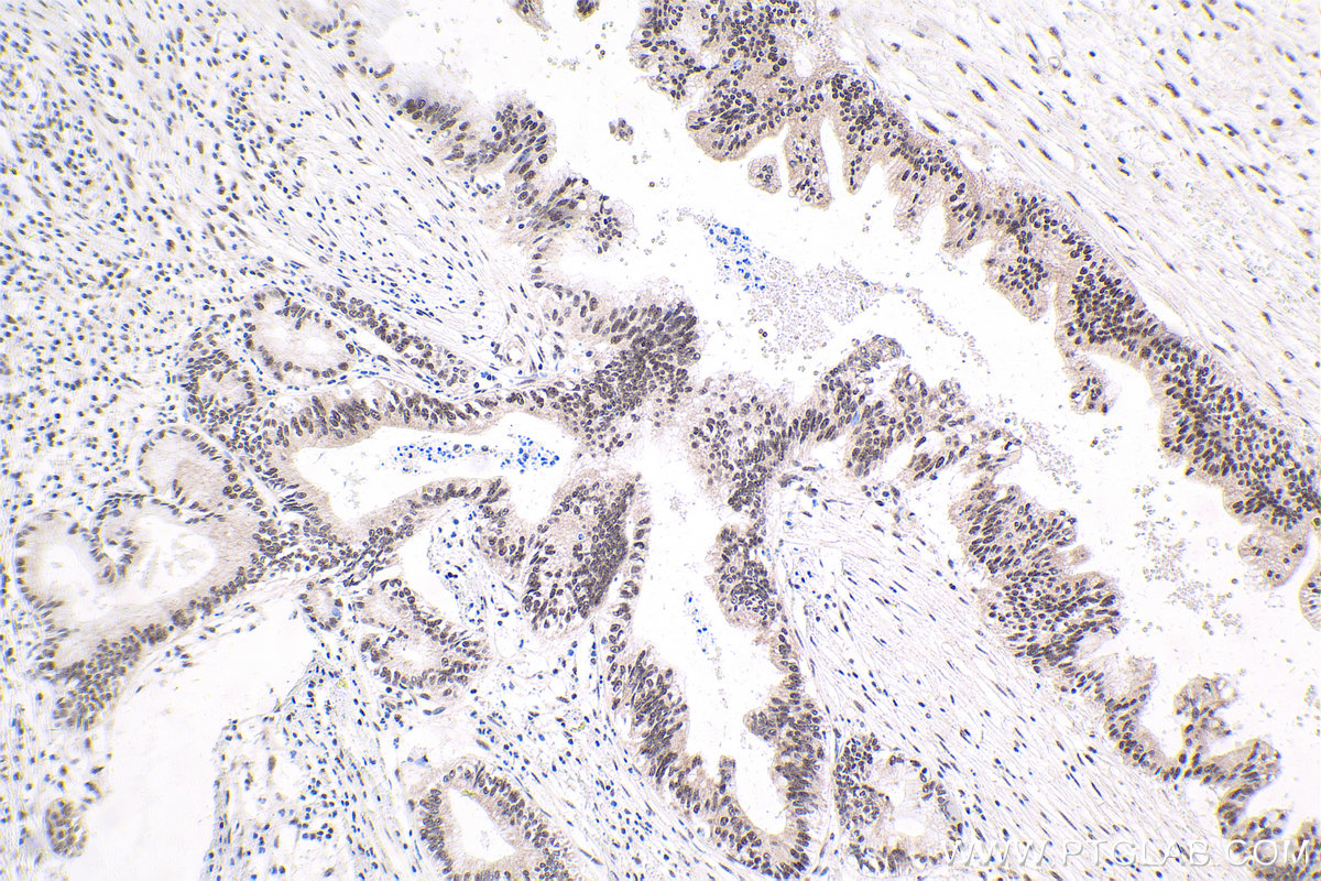 Immunohistochemical analysis of paraffin-embedded human pancreas cancer tissue slide using KHC1786 (THOC7 IHC Kit).