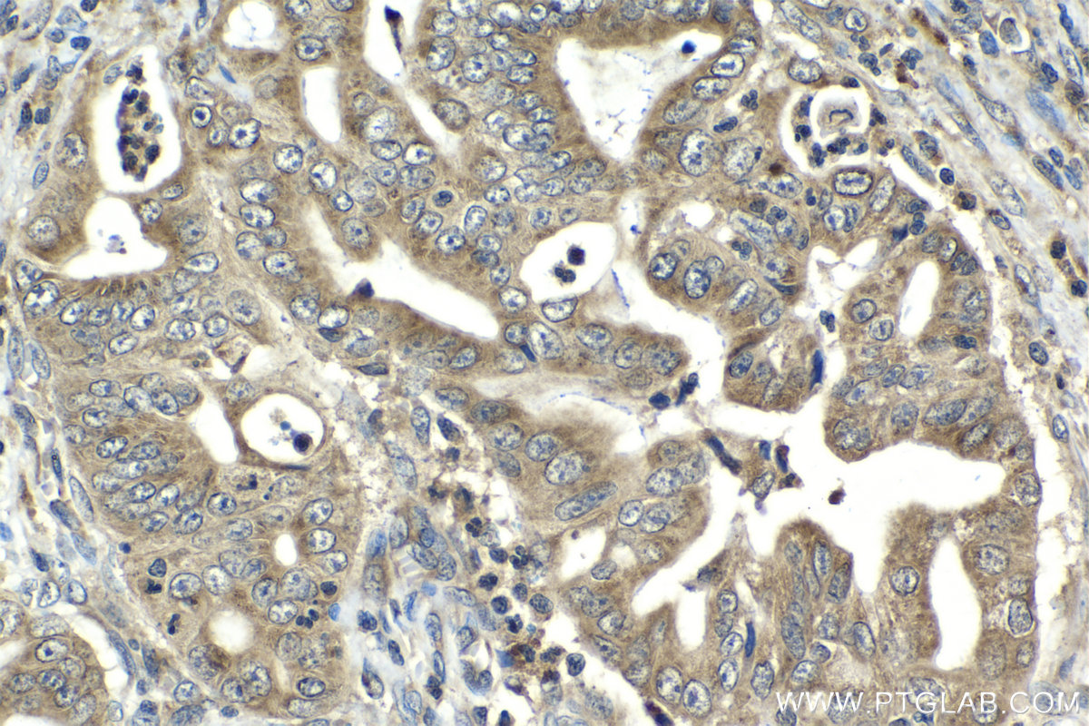 Immunohistochemical analysis of paraffin-embedded human stomach cancer tissue slide using KHC2109 (TMEM127 IHC Kit).