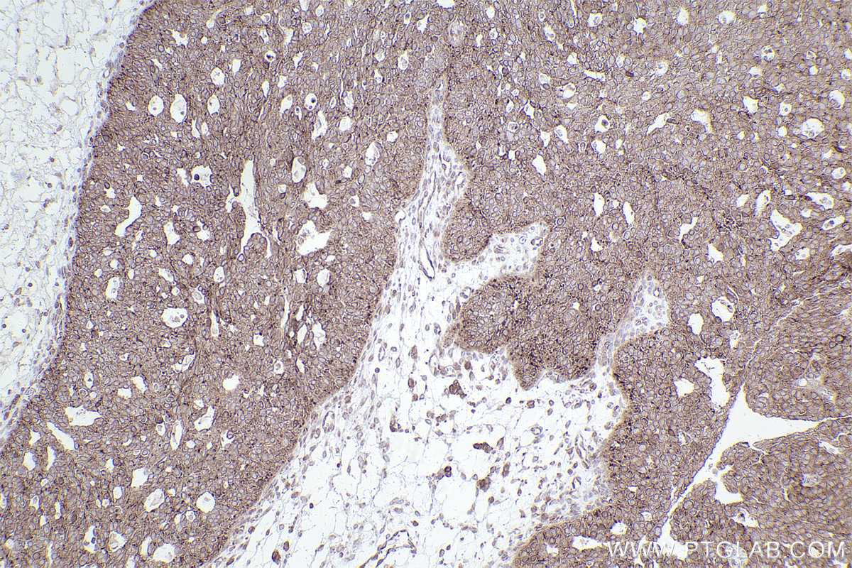 Immunohistochemical analysis of paraffin-embedded human ovary cancer tissue slide using KHC2541 (TMEM41B IHC Kit).