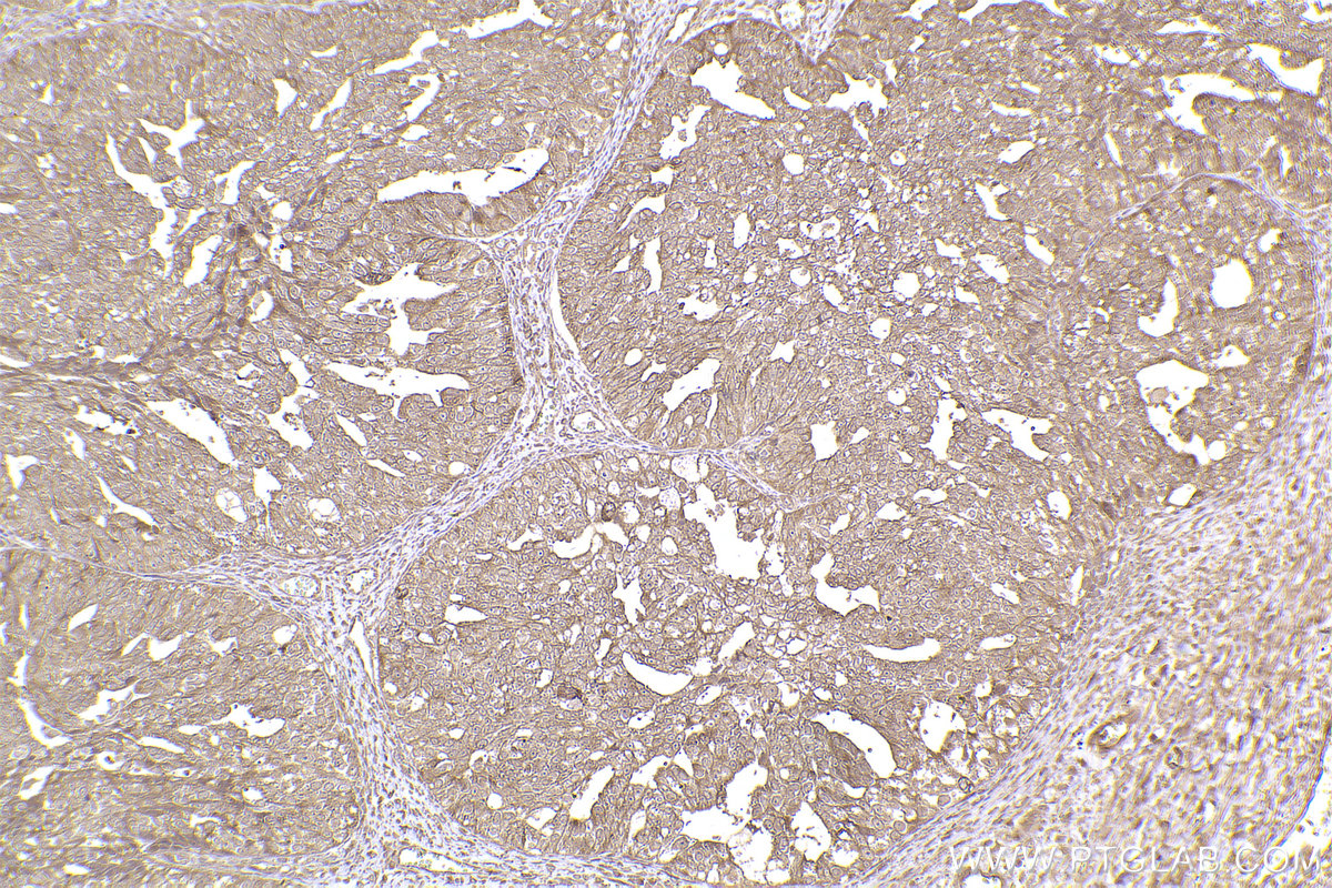 Immunohistochemical analysis of paraffin-embedded human ovary cancer tissue slide using KHC2443 (TNFAIP1 IHC Kit).