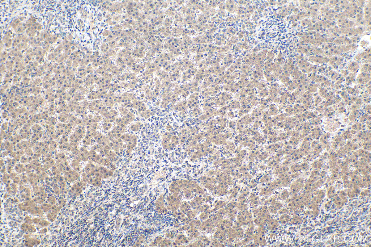 Immunohistochemical analysis of paraffin-embedded human liver cancer tissue slide using KHC1492 (TNKS IHC Kit).