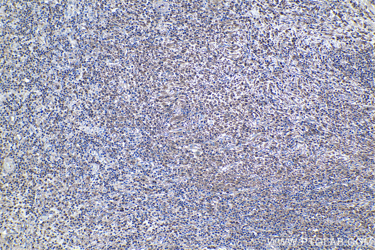 Immunohistochemical analysis of paraffin-embedded human colon cancer tissue slide using KHC0972 (TOLLIP IHC Kit).