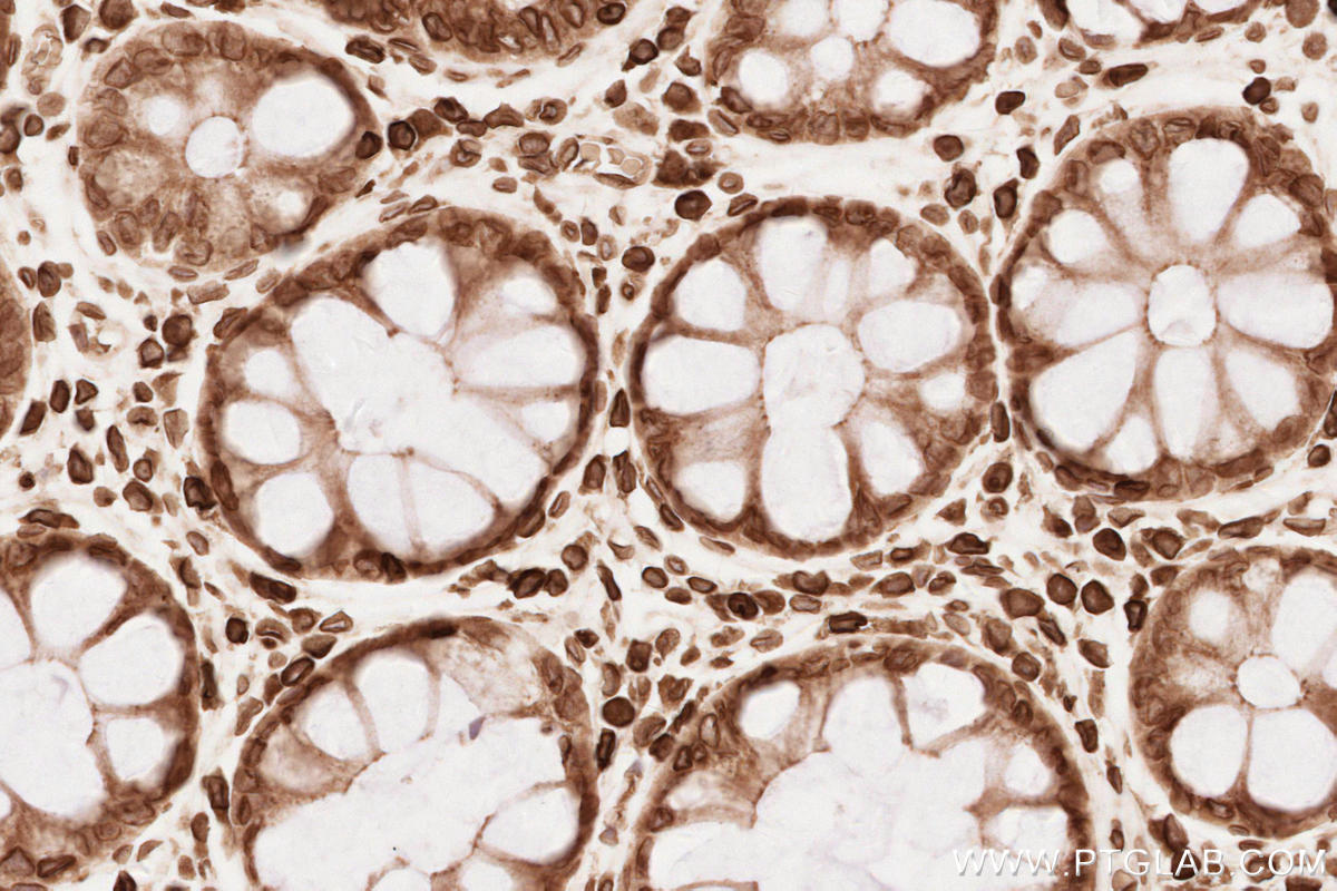 Immunohistochemical analysis of paraffin-embedded human rectal cancer tissue slide using KHC2546 (TOR1AIP1 IHC Kit).