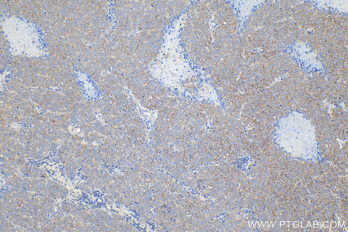 Immunohistochemical analysis of paraffin-embedded human ovary tumor tissue slide using KHC2125 (TRIO IHC Kit).