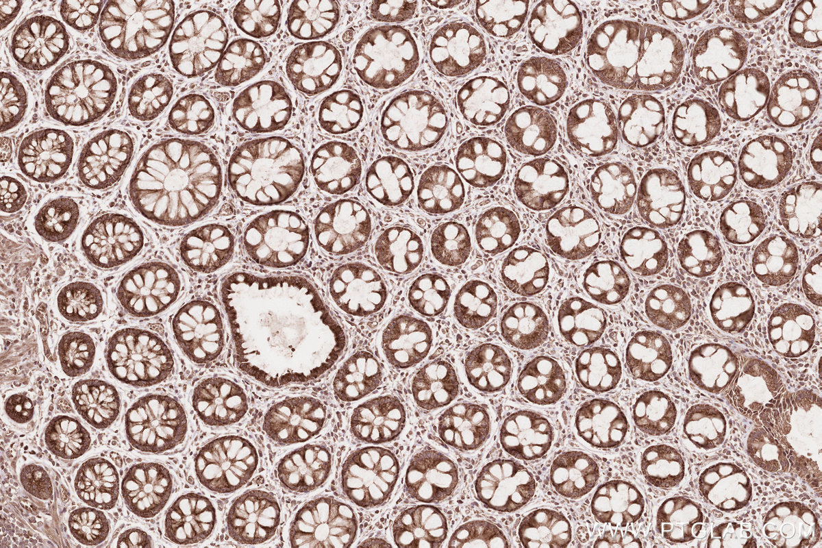 Immunohistochemical analysis of paraffin-embedded human rectal cancer tissue slide using KHC2575 (TTC19 IHC Kit).