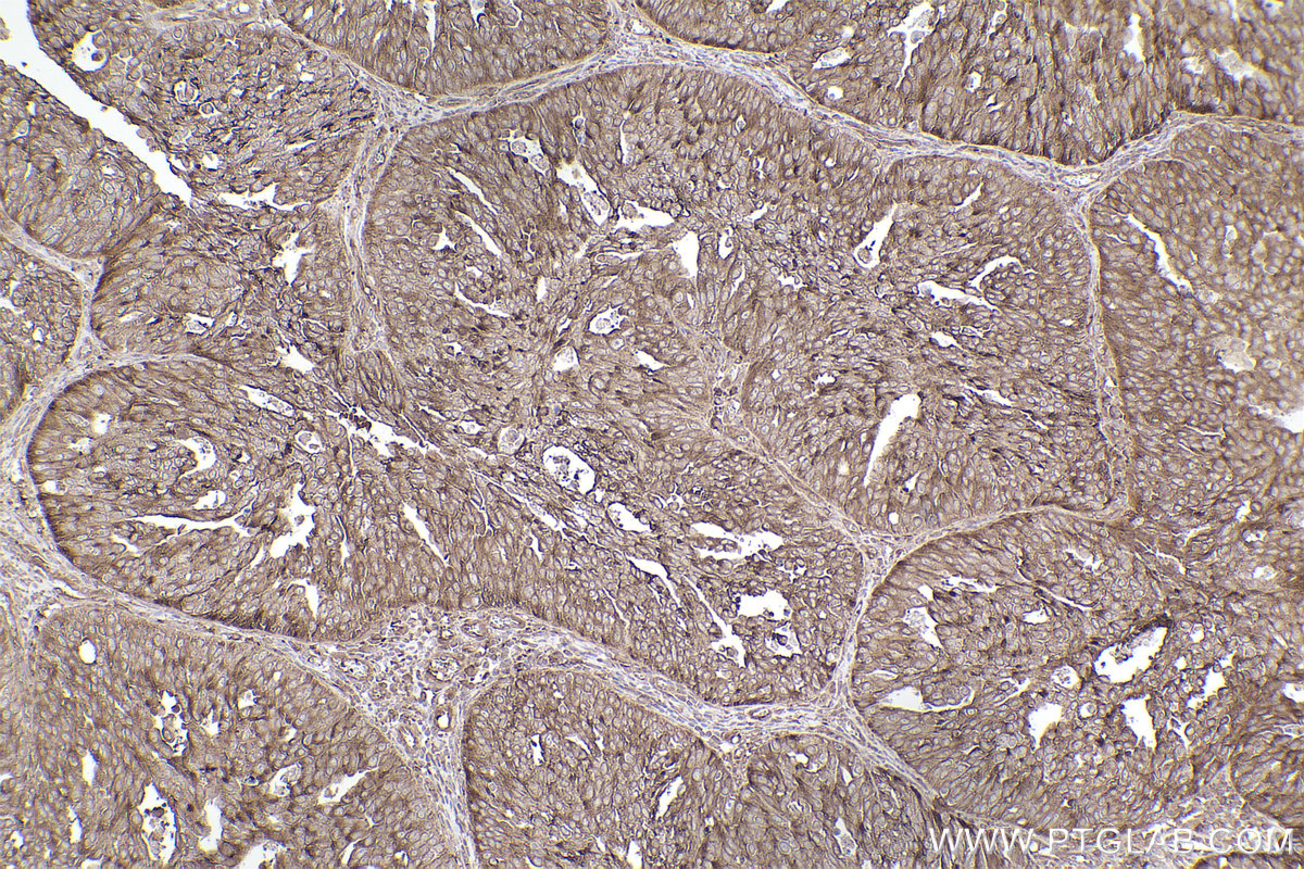 Immunohistochemical analysis of paraffin-embedded human ovary cancer tissue slide using KHC2407 (TWF1 IHC Kit).