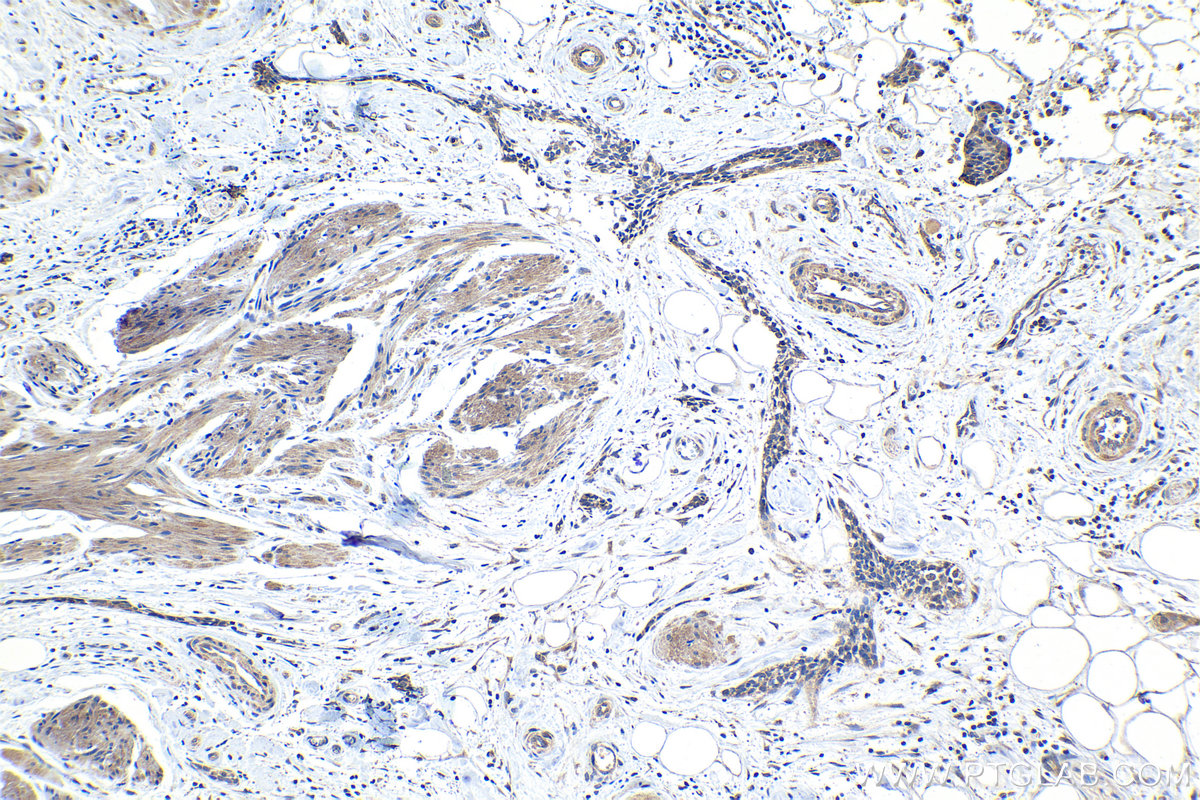 Immunohistochemical analysis of paraffin-embedded human urothelial carcinoma tissue slide using KHC1189 (UBTD1 IHC Kit).
