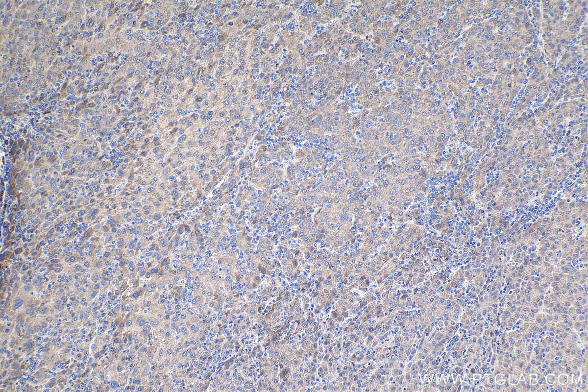 Immunohistochemical analysis of paraffin-embedded human liver cancer tissue slide using KHC1486 (UFL1 IHC Kit).