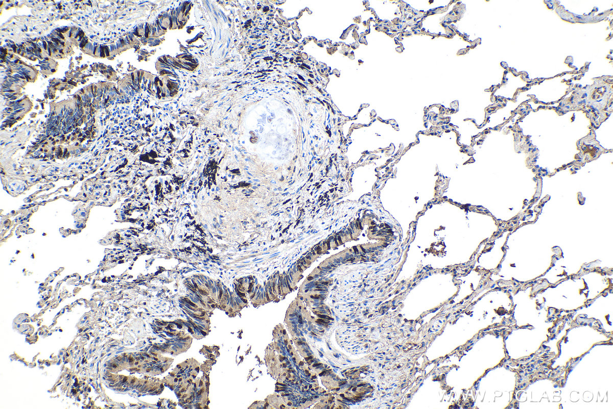 Immunohistochemical analysis of paraffin-embedded human lung cancer tissue slide using KHC1091 (Uteroglobin/SCGB1A1 IHC Kit).