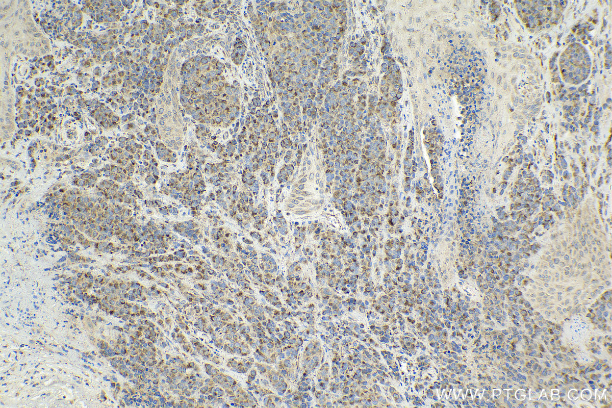 Immunohistochemical analysis of paraffin-embedded human malignant melanoma tissue slide using KHC2110 (VAMP4 IHC Kit).