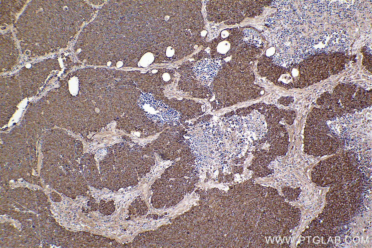 Immunohistochemical analysis of paraffin-embedded human lung cancer tissue slide using KHC2312 (VAV2 IHC Kit).