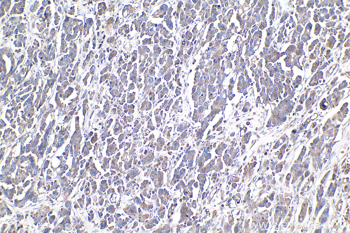 Immunohistochemical analysis of paraffin-embedded human colon cancer tissue slide using KHC1074 (VISTA IHC Kit).