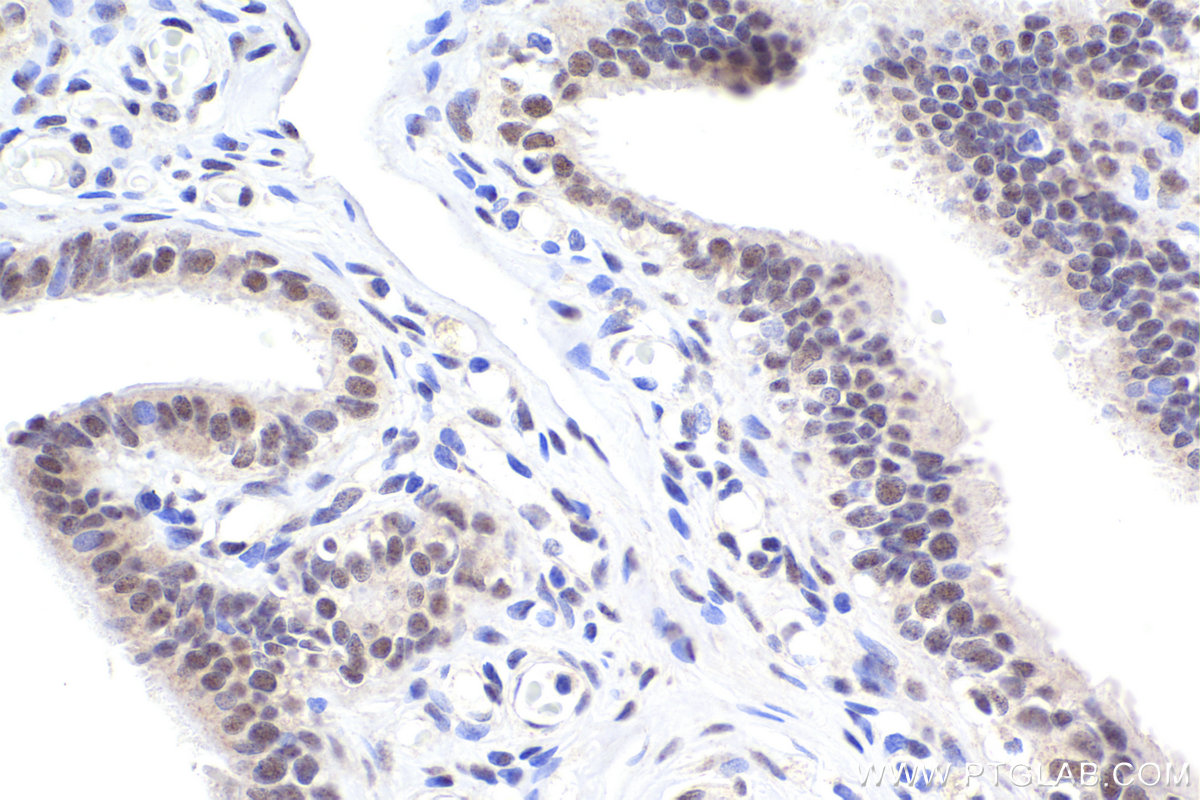 Immunohistochemical analysis of paraffin-embedded human ovary tumor tissue slide using KHC2210 (XPA IHC Kit).