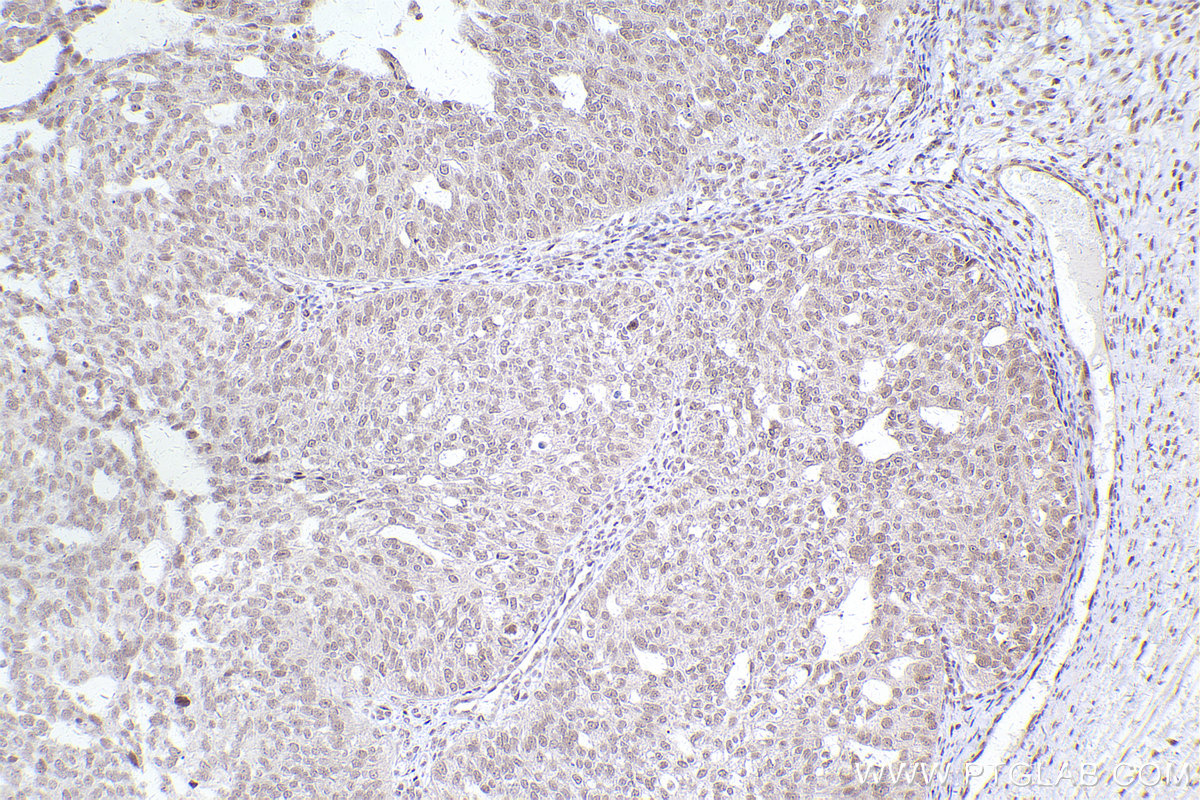 Immunohistochemical analysis of paraffin-embedded human ovary cancer tissue slide using KHC2542 (ZNF326 IHC Kit).