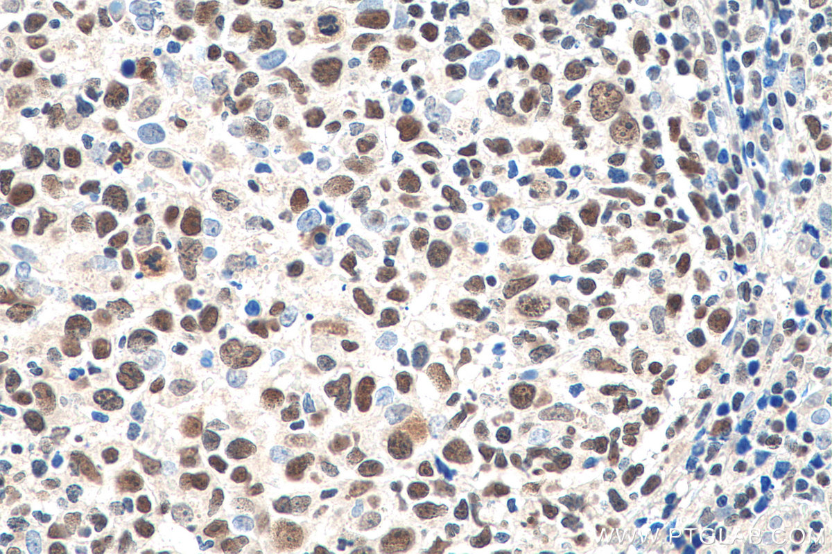 IHC staining of human lymphoma using 66966-1-Ig (same clone as 66966-1-PBS)