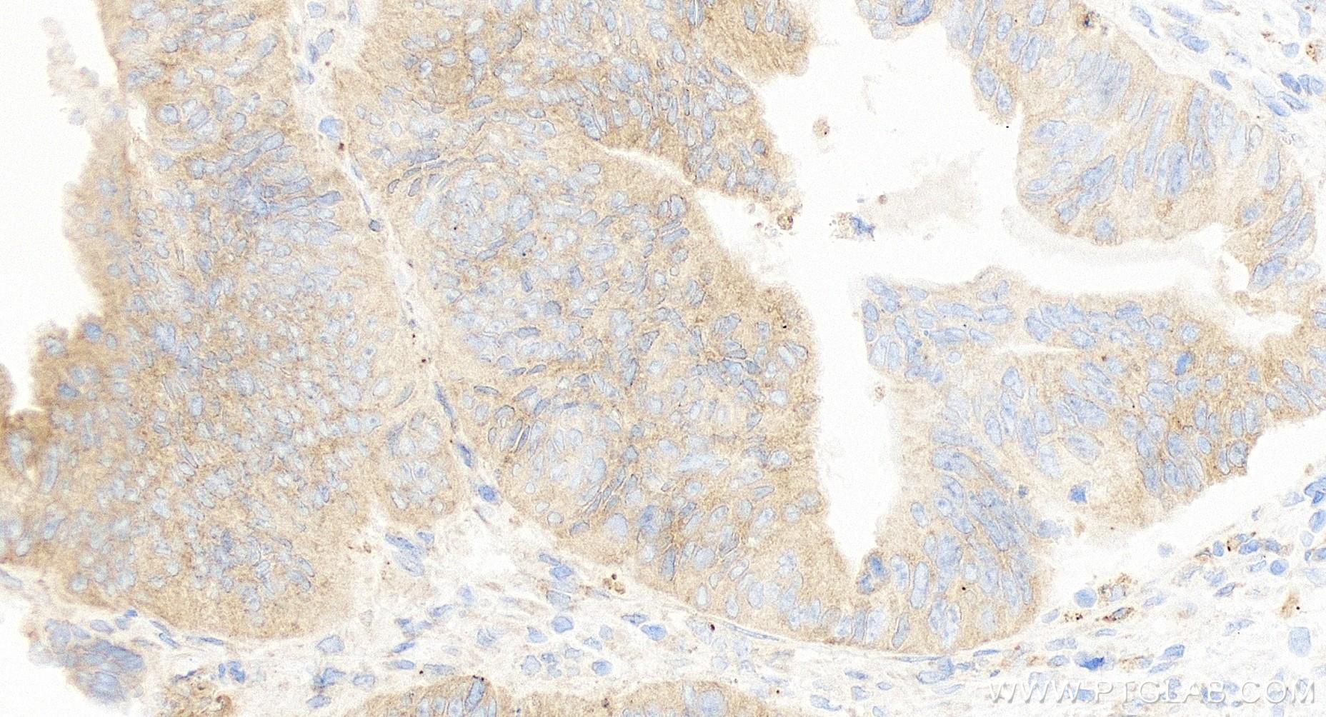 IHC staining of human colon cancer using 84411-5-RR