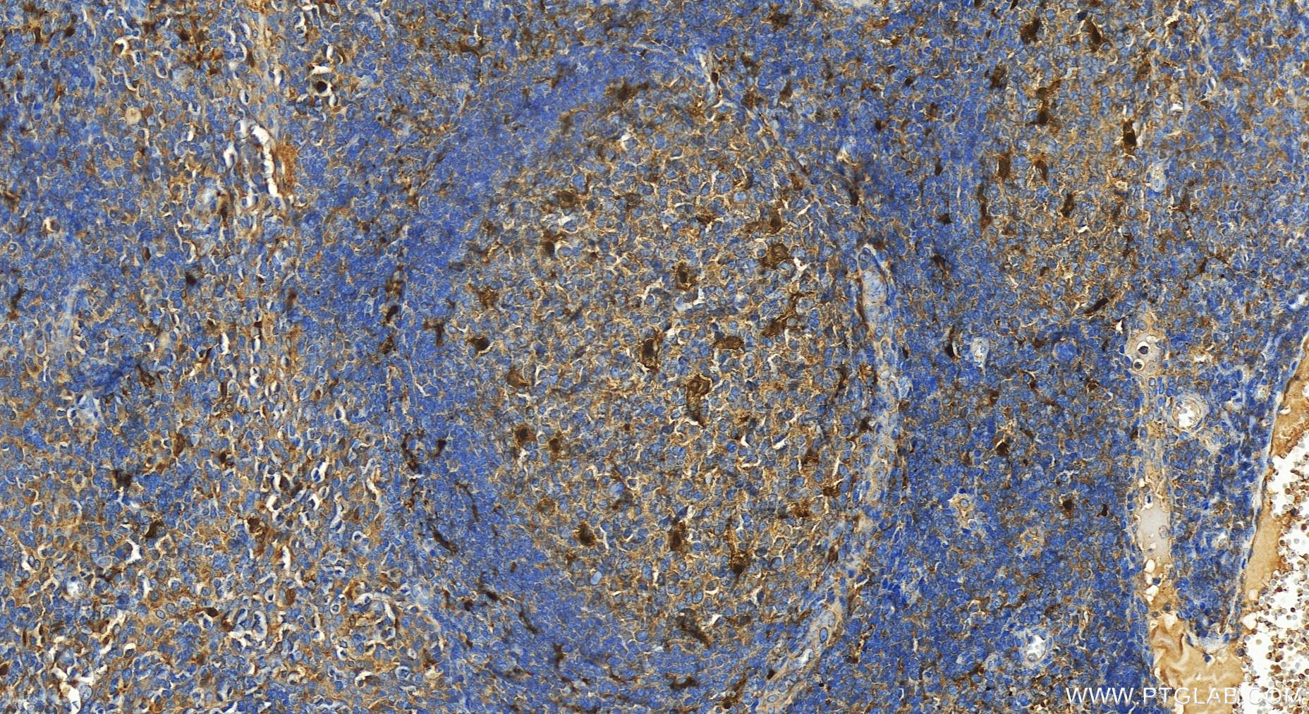 IHC staining of human tonsillitis using 82907-1-RR (same clone as 82907-1-PBS)