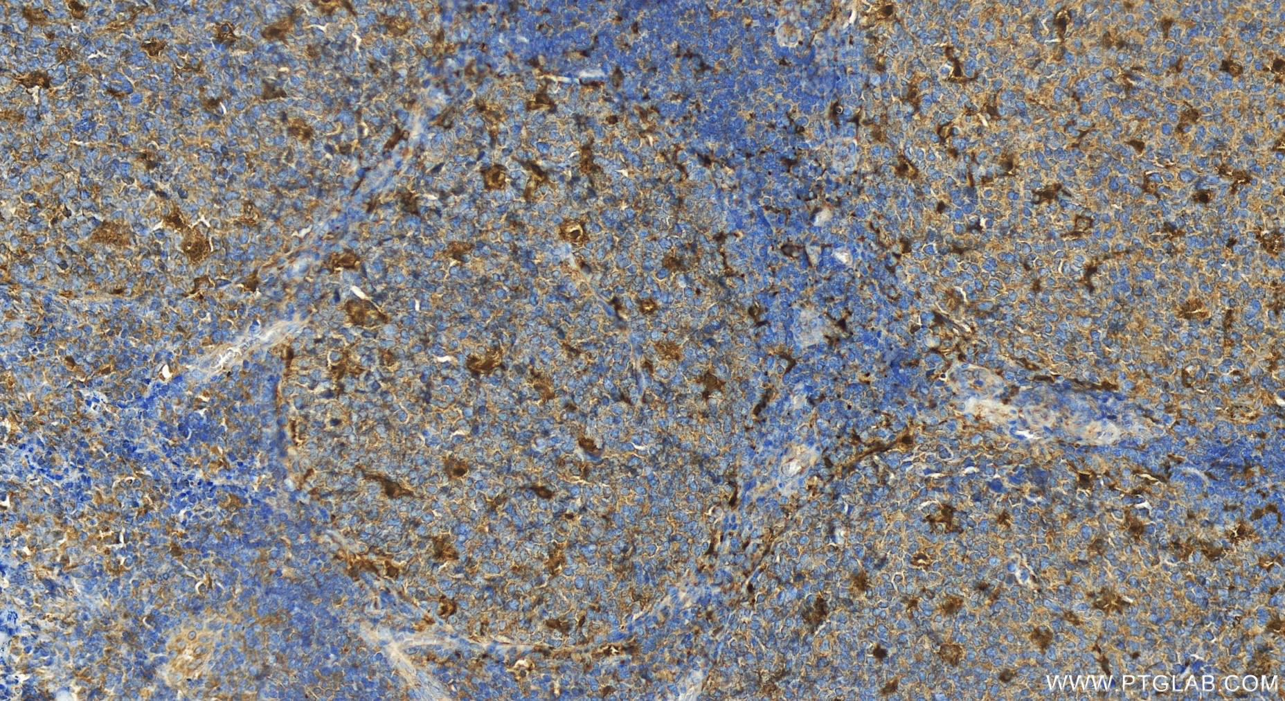 IHC staining of human tonsillitis using 82907-1-RR (same clone as 82907-1-PBS)