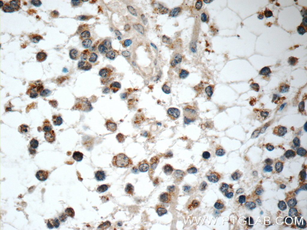 IHC staining of human gliomas using 24173-1-AP