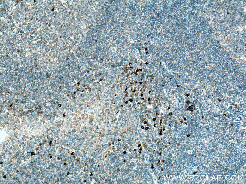 IHC staining of human tonsillitis using 22646-1-AP