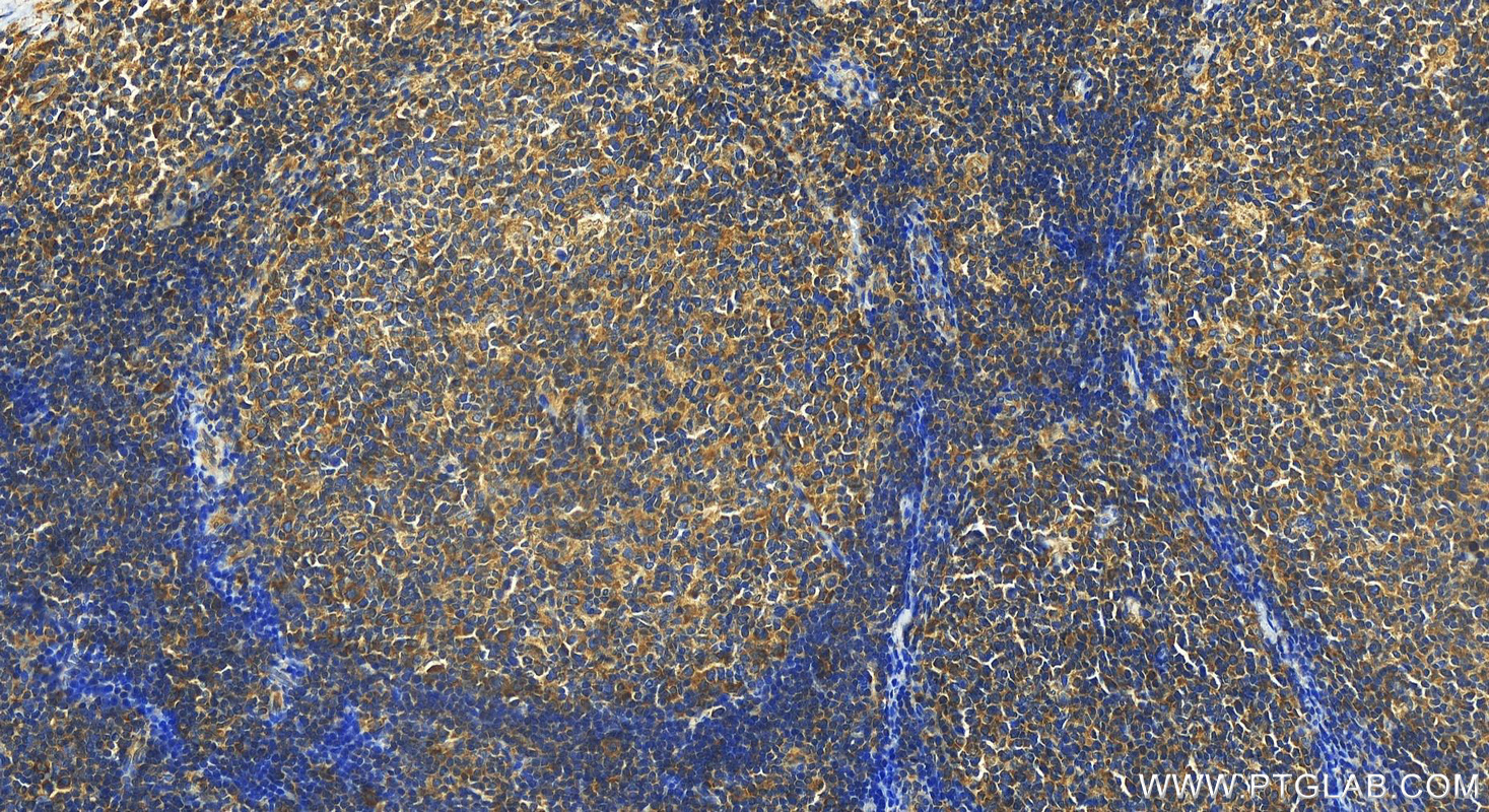 IHC staining of human tonsillitis using 30533-1-AP