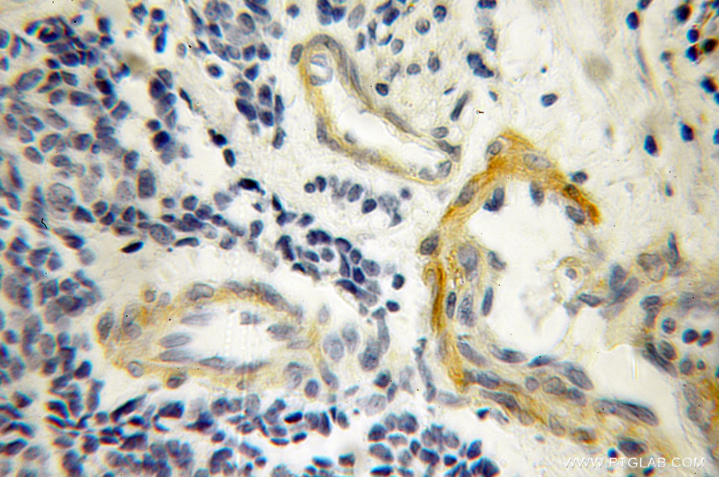 IHC staining of human lung cancer using 12962-1-AP