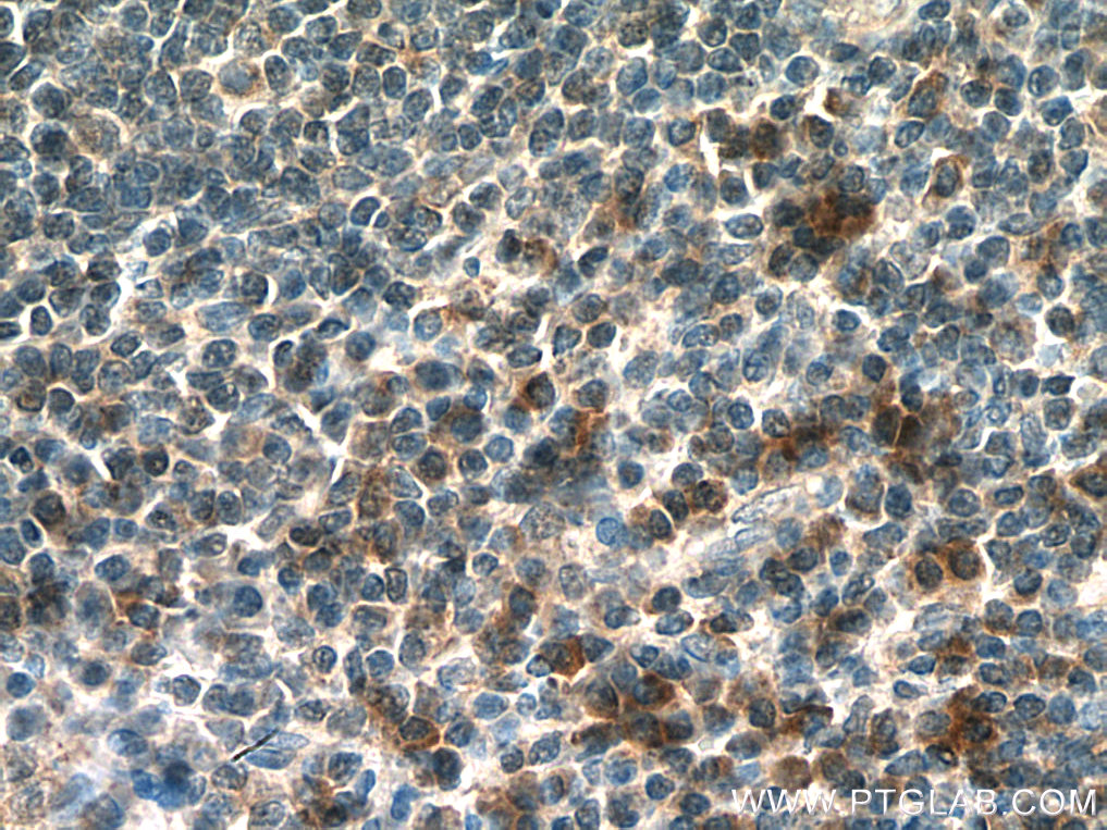 IHC staining of human tonsillitis using 28455-1-AP