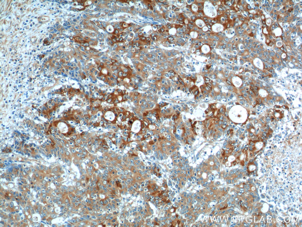 IHC staining of human colon cancer using 13082-1-AP