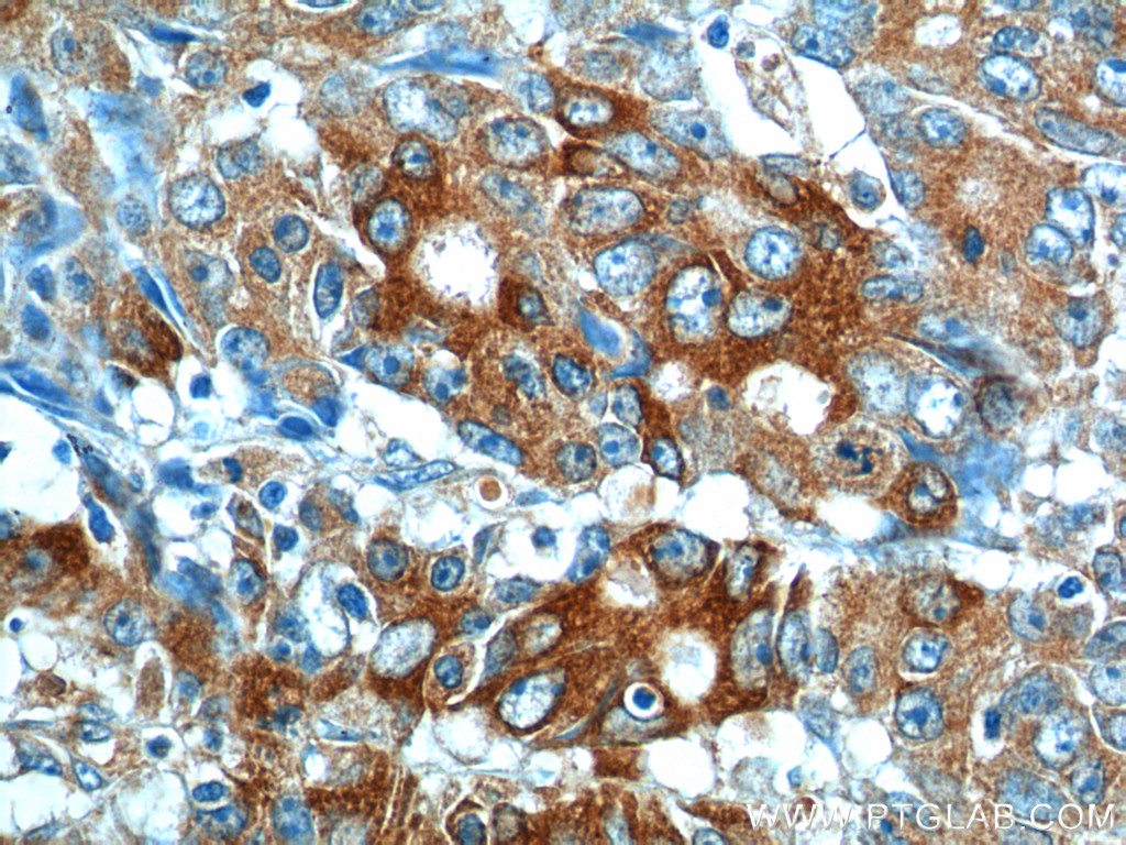 IHC staining of human colon cancer using 13082-1-AP