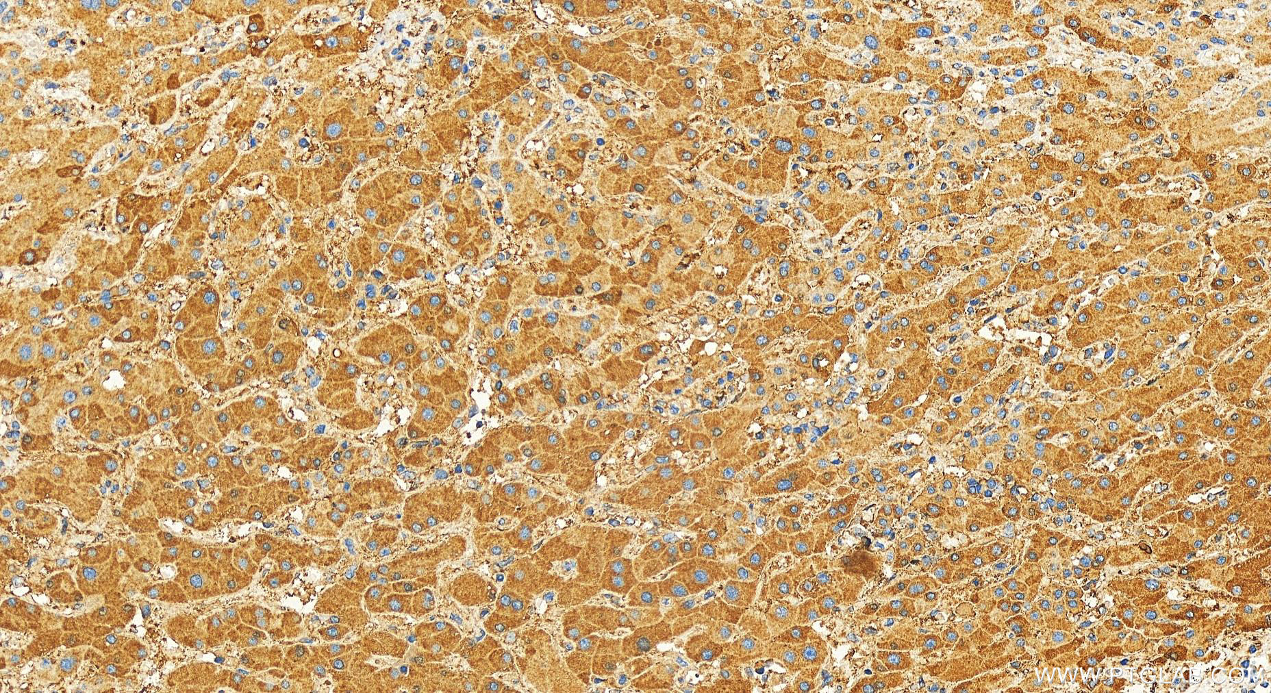 IHC staining of human intrahepatic cholangiocarcinoma using 30966-1-AP