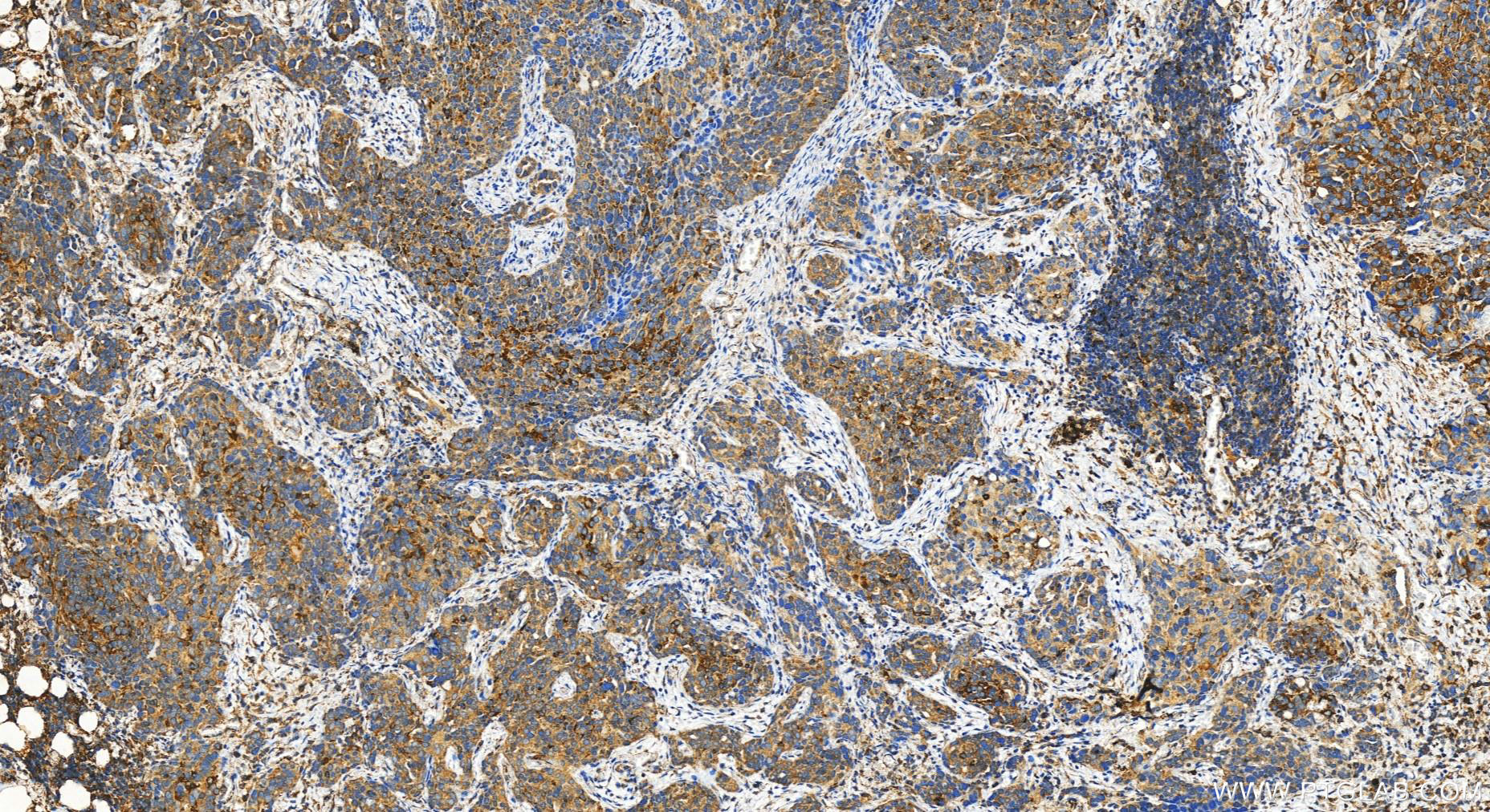 IHC staining of human ovary cancer using 30966-1-AP