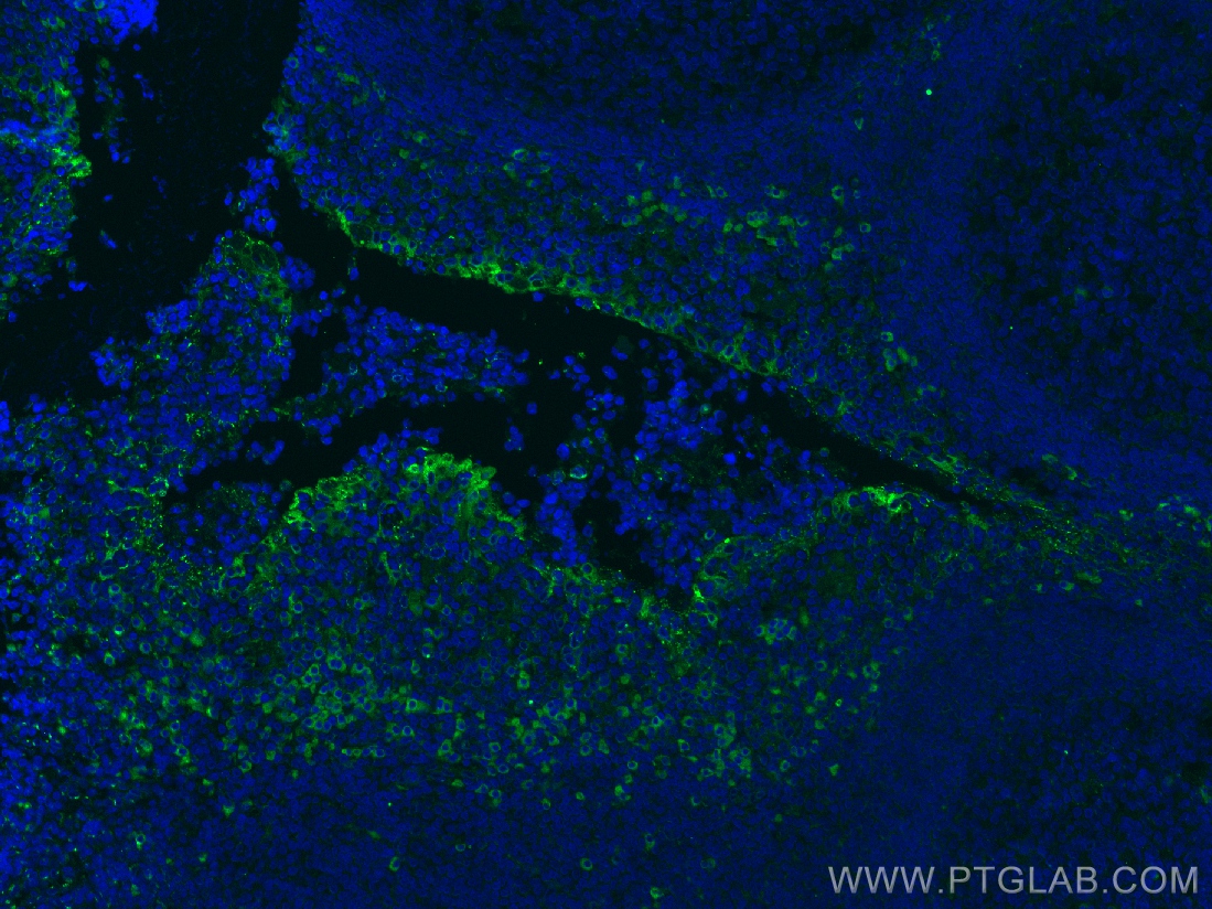 IF Staining of human tonsillitis using 60306-1-Ig